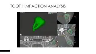 Acteon Imaging Suite 3D - impacted 38 with dilaceration root