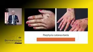 Masterclass: Cutaneous Porphyrias made simple