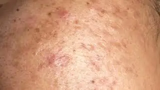 This Silent Fire Is Wrecking Your Health
