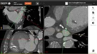 New FEops HEARTguide Release, LAAo MPR