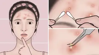 ASMR Acne Treatment At Home | Pimple, Acne Removal Animation | @ASMRidhu