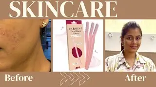 Skincare | acne prone | oily skin | Pcos/Pcod journey 