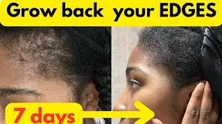 Grow Back Your EDGES in 7 Days Using Clove & Fenugreek! (Natural Remedy That Works Fast)