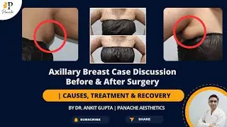 Axillary Gland Tissue | Axillary Fat Removal | Armpit Fat Removal - Get Rid of Axillary Swelling