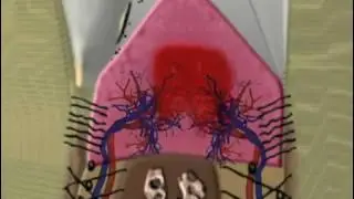 Nash Family Dentistry Shares Animation Of Periodontal Disease in Vicksburg, MS