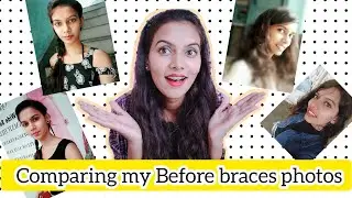 Comparison of my Before braces pictures 😄😝#beforeandafterbraces #howto #beforeandafter #braces