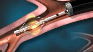 Bronchial Thermoplasty for Asthma - AnMed