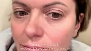 Melasma and Pigmentation Treatment