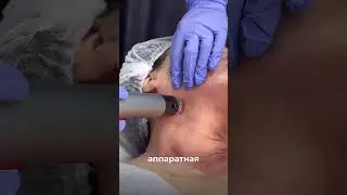 Микроигольчатый RF-лифтинг на аппарате Genius Lutronic #skincare #laser #beauty#aesthetic