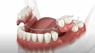 Dentures Explained | Complete Tooth Replacement Solutions with Stallings Dental in St. Louis