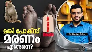1098: മങ്കിപോക്&zwnj;സ്  മരണം ഉണ്ടാക്കുമോ? എങ്ങനെ ഒഴിവാക്കാം? Can monkey pox cause death?!!