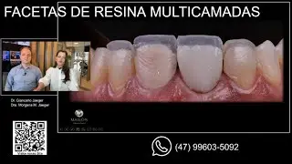 Facetas de Resina Multicamadas na Arcada Superior e Inferior - Passo a Passo