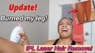 Burned My Leg with IPL Laser Hair Removal 2 MONTH UPDATE // Lux Skin