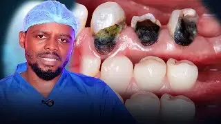 GUCUKUKA AMENYO /DENTAL CARIES or TOOTH CAVITY /DECAY | DR.ERNEST