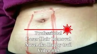 How fast Laser Hair removal can be!