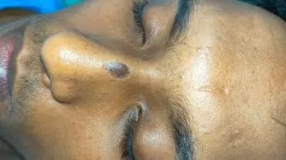 scar revision surgery result after 1 week