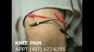 Dry Needling Acupuncture with Electrical Stimulation for Knee Pain I Orlando Area Chiropractor