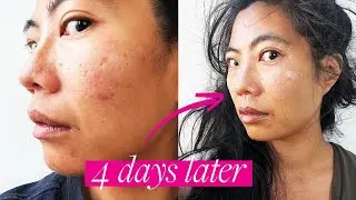 I Fixed My BAD Skin Barrier in 4 DAYS and You Can TOO!