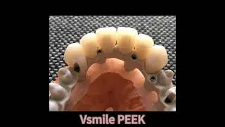 Vsmile PEEK