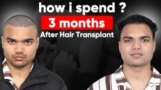 Hair Transplant in Delhi | Best Results & Cost of Hair Transplant in Delhi (HX - Xs0j)