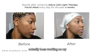 Elevate Your Self-Care Game: Experience the Magic of the Aduro LED Light Therapy Mask!