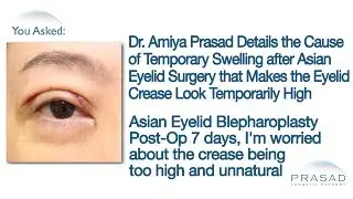 Why Temporary Swelling Concentrates in the Upper Eyelids after Asian Double Eyelid Surgery
