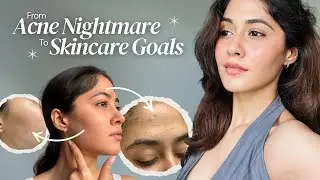 From Acne Nightmare to Skin Goals: My Journey to Clear Skin