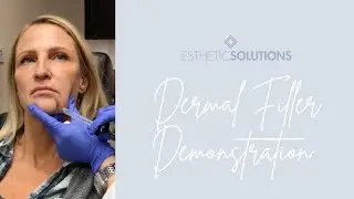 Dermal Filler LIVE Demonstration &mdash; Esthetic Solutions Med Spa