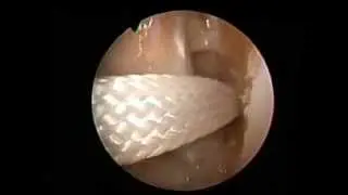 FH Orthopedics, Inc. CoLS Graft Insertion