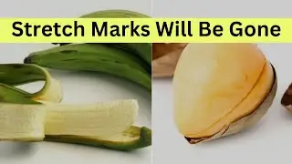 Stretch Marks Will Be Gone With This Home Remedy Hack
