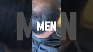 WATCH THIS VIDEO GUYS | HAIR LOSS SOLUTION FOR MEN | #hairsystems #barber #hairlosstreatment