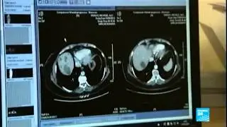 علاج مناعي للسرطان