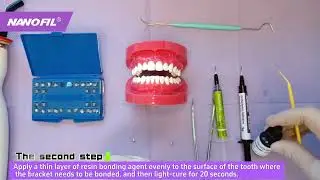 NANOFIL Orthodontic Adhesive Dental Resin&mdash;for bonding metal/ceramic brackets to enamel.
