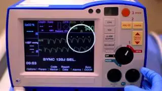 R Series Synchronized Cardioversion (Software prior to v 14)