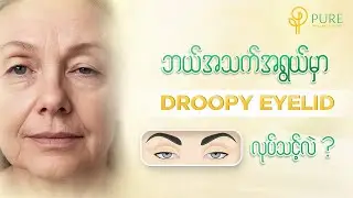 ဘယ်အသက်ရွယ်မှာ Droopy Eyelid လုပ်သင့်လဲ ?