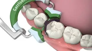 Garrison Dental Composi-Tight&reg; 3D Fusion&trade; Wide Prep ring placement