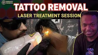  &ldquo;Tattoo Removal Laser Treatment Session | Before & After Results&rdquo;