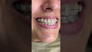 Braces Colors Before and After 8 weeks