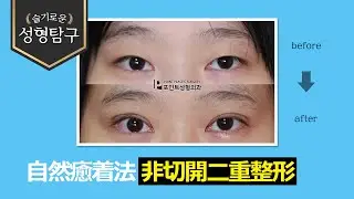 【韓国二重整形】自然癒着法の二重整形症例(手術直後)