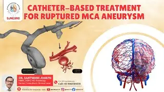 Catheter-Based Treatment for Ruptured MCA Aneurysm | Life-Saving Neurointervention Case