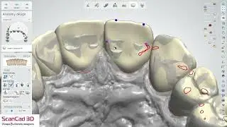 3shape 10-02-2025 K crowns