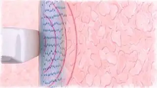 Vaginal Rejuvenation Technology - Viveve