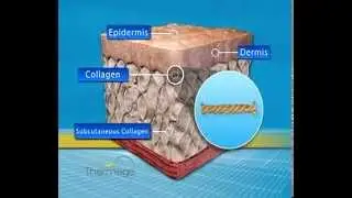 Tighten Skin Without Surgery