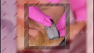 Mens Waxing on the cheek- Around the beard | Starpil Wax Black Film Wax
