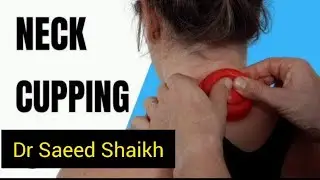 Neck Pain Relief by Cupping Therapy | Natural & Effective Treatment #neckpainrelief 