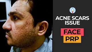 SEVERE ACNE SCARS 😱 - Advance PRP Treatment