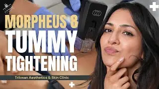 How I Tightened My Tummy Skin Post-Baby | Dr. Zoya&rsquo;s Morpheus8 Story