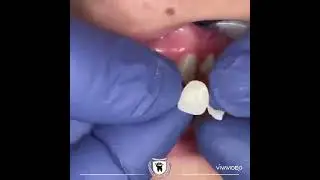 bridge maryland pour remplacer une dent manquante