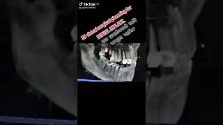 3D Virtual Surgical Planning for Dental Implant