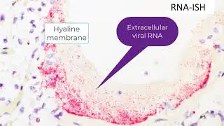 Detection of SARS-CoV-2 in paraffin embedded tissue